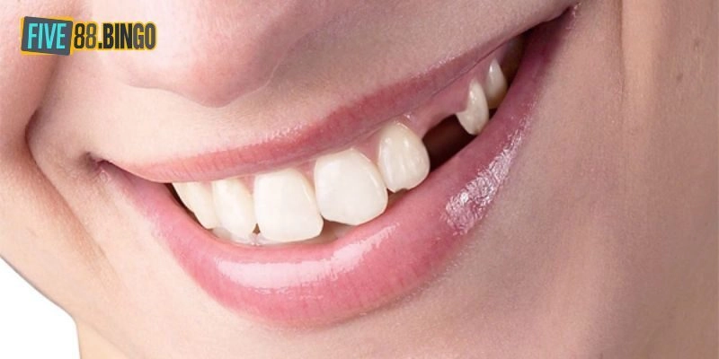 Nằm Mơ Rụng Răng Đánh Con Gì Dễ Trúng Lô Đề Nhất?